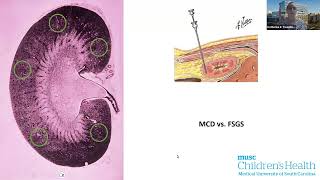 Pediatric FSGS and the Utility of Lipopheresis CME Recording [upl. by Ikaz]