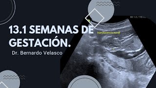 131 SEMANAS HEMATOMA RETROCORIAL DE 47 CM TRANSLUCENCIA NUCAL 025 mm [upl. by Ecnarretal202]