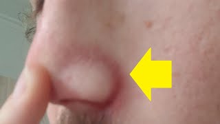 how to get rid of redness around nose crease fast [upl. by Denyse]