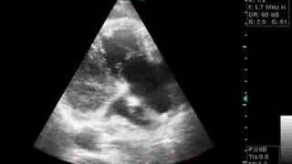 pulmonary embolus [upl. by Bugbee]