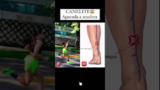 CANELITE😱Aprenda a resolver [upl. by Gerty]