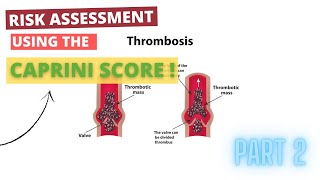 Risk Assessment using the Caprini Score [upl. by Millford]