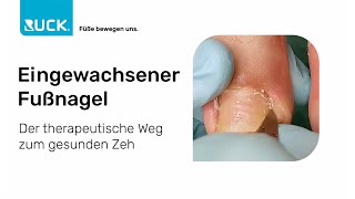 Eingewachsener Fußnagel  der therapeutische Weg zum gesunden Zeh [upl. by Evangeline]