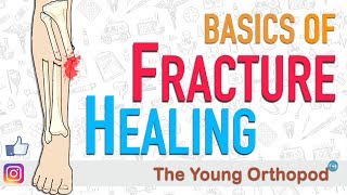 Fracture Healing  ANIMATION  BASICS  The Young Orthopod [upl. by Apostles]