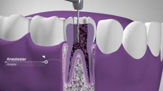 Endodoncia Dentimex [upl. by Lamphere]