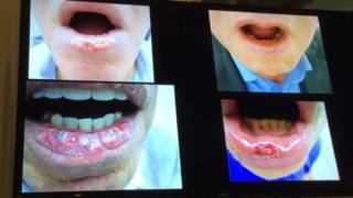 Queilitis actinica Como lo maneja usted Bucaramanga 2016 [upl. by Denise]