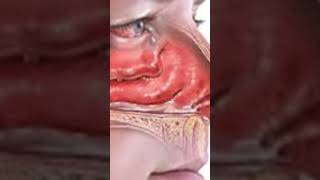 Allergic Rhinitis and its treatment naak ki allergy eska ilajshorts viralvideo [upl. by Enyal]