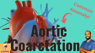 Aortic Coarctation Common ANOMALY in the Vascular System What is it In 5 MINUTES [upl. by Crandell984]