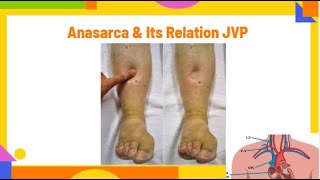 Anasarca amp its relation JVP  grading for nonpitting edema  anasarca PhysiotherapyKnowledge [upl. by Micco]