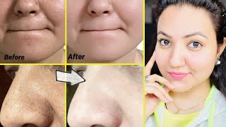 कितने भी मुश्किल Blackheads Whiteheads कील सफेद दाने हों follow करें ये 5 steps और पाएँ चमकदार skin [upl. by Heath519]