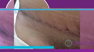 Abdominoplastia  Proceso de cicatrización [upl. by Kenna]