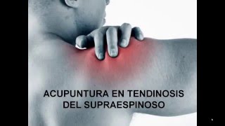 ACUPUNTURA EN TENDINOSIS DEL SUPRAESPINOSO [upl. by Elisabeth]