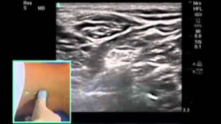 Ultrasound Sciatic Nerve Blockade Casals Approach part 2 [upl. by Zosema]