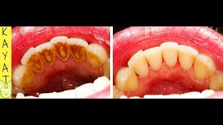 COMMENT DÉTARTRER LES DENTS A LA MAISON POUR AVOIR DES DENTS PROPRES AVEC CETTE RECETTE FACILE👍😀 [upl. by Ahseiat]