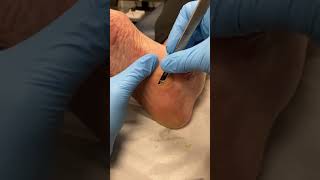 Watch a Podiatrist Remove Hard Skin and Calluses from the Midfoot using Ergonx and Docpods [upl. by Nomla]