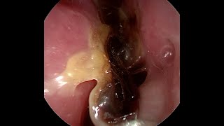 BIG BOOGERS and SNOT after Septoplasty [upl. by Marin]