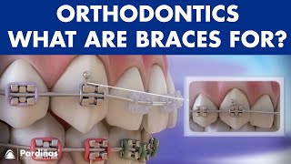 How Braces Work Elements of the orthodontic treatment and its role © [upl. by Fronniah]