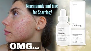 I TESTED THE ORDINARY NIACINAMIDE AND ZINC SERUM FOR MY ACNE SCARS ONE MONTH Shocked by this [upl. by Jacinda]