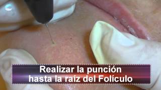 Hirsutismo Vello Facial con Plasmalaser SCORPION [upl. by Nylrats]