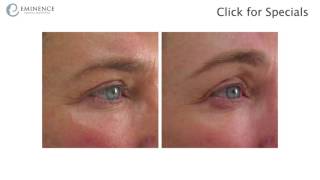 Ultherapy Before amp After Photos Princeton NJ  Non Surgical Skin Lift [upl. by Nniuqal]