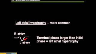 1215 Lead ECG Atrial Hypertrophy [upl. by Ramos169]