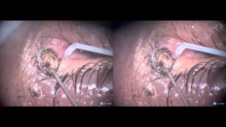 Large naevus on punctum and canaliculus removal with Fugo blade [upl. by Llertnom]