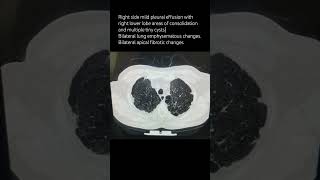 Right side mild pleural effusion with right lower lobe areas of consolidationpulmonologist [upl. by Hsepid115]