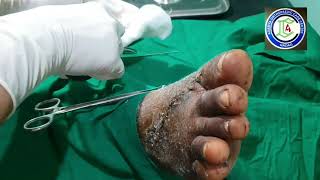 Dorsum Foot injury  Accidental axe injury foot  Kwire removal foot  Adamya Hosp videos [upl. by Frye]