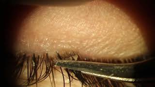 Teenager Blepharitis Removal [upl. by Klump366]