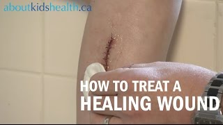 How to care for a healing wound  AboutKidsHealth at The Hospital for Sick Children [upl. by Idolah510]