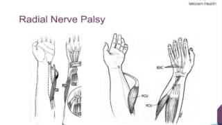 Upper Limb Tendon Transfers by Dr Scott Tulloch [upl. by Esirec71]