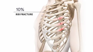 Management of Acute and Chronic Rib Fractures [upl. by Obadiah]