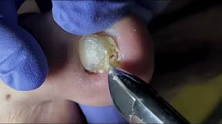 Ingrown Toenail Removal  Pedicure Treatment and Very Satisfying  Best Satisfying Nail Cutting [upl. by Nnaear610]