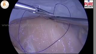 Laparoscopic suturing  Quick learning in Five minutes [upl. by Retsehc23]