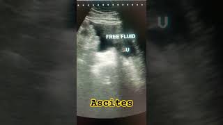 Ascites ultrasound abdomen ascites medical study shortfeed shortsviral hepatitisc ytviral [upl. by Fiske168]