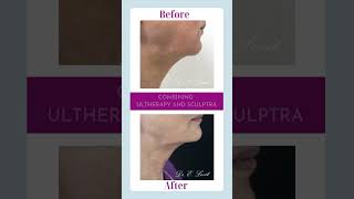 Combining Ultherapy and Sculptra [upl. by Ivah235]