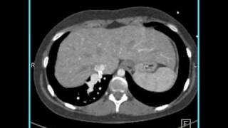 Total anomalous pulmonary venous return [upl. by Delogu867]