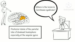 Gerstmann syndrome [upl. by Eanwahs]