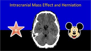 Imaging of Intracranial Mass Effect and Brain Herniation Made Easy [upl. by Raney]