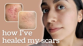 Healing Hyperpigmentation  Deep Pitted Acne Scars this is what I’ve done [upl. by Lleraj]