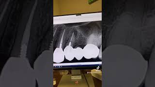 “Premolar root canals are so easy” [upl. by Aitam520]