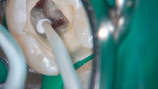 DRendo  Full pulp chamber pulpotomy in a mandibular second molar [upl. by Adahs240]