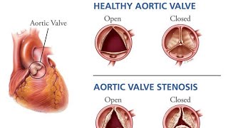 Aortic Stenosis [upl. by Callida]