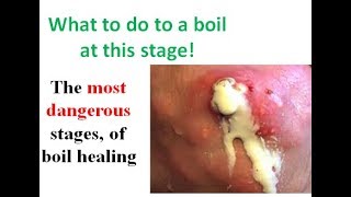 how to heal a boil after its been popped plus tips to prevent severe and chronic boils [upl. by Lowe530]