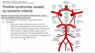 Pontine syndromes caused by ischemic infarcts [upl. by Ambrogino]