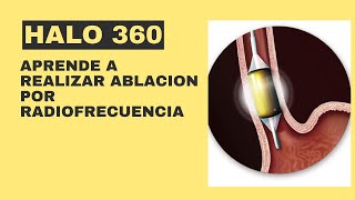 Aprende a realizar Ablación por radiofrecuencia HALO en 360º [upl. by Ainwat]