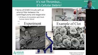 Hemolysis in Pediatric ECLS [upl. by Aela]