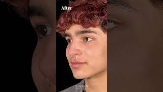 Before and After Non Surgical Nose Job nonsurgicalrhinoplasty [upl. by Sehguh584]