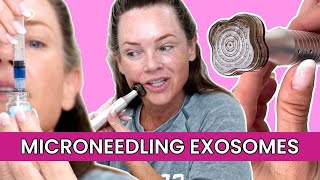 Can Microneedling With Exosomes Erase Wrinkles [upl. by Maon]