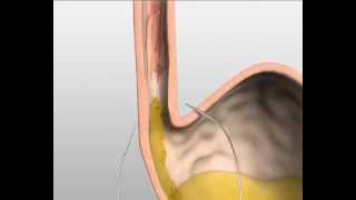 Endostim slokdarm kringspier stimulatie tegen zuurbranden [upl. by Tirma99]